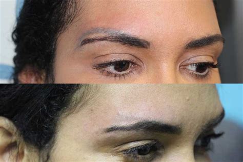 Cosmetic And Eyebrow Tattoo Removal Removery