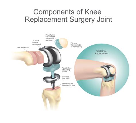 reasons  avoid  delay knee replacement surgery thirdage