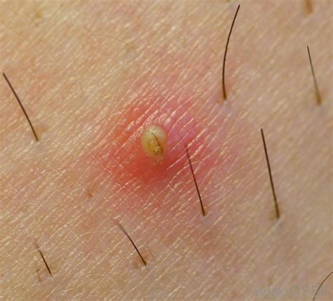 Infected Ingrown Hair Symptoms And Treatments New