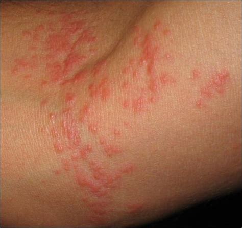 itchy skin rash bumps  symptoms treatment pictures
