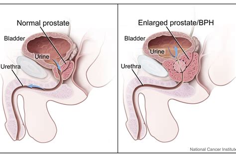 what are some common prostate problems