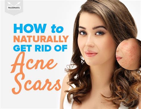 how to naturally get rid of acne scars with oils and home remedies