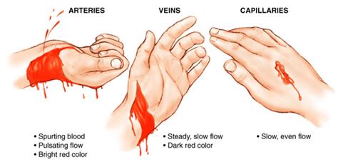 types  bleeding   aid  aid