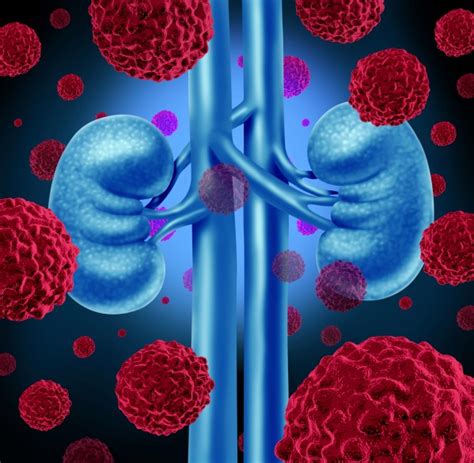 prostate cancer risk lower in type 2 diabetics renal and