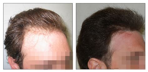 fue hair transplant  sessions  grafts fue hair transplant hair clinic grafting hair