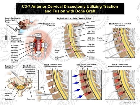 Female C3 7 Anterior Cervical Discectomy Utilizing