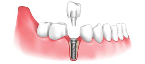 dental implant procedures american academy  periodontology