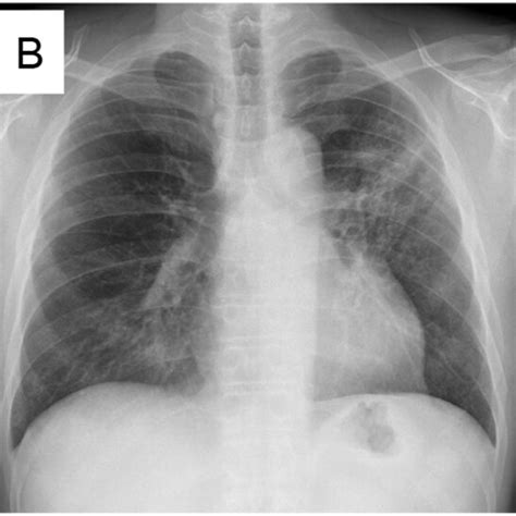 Chest X Ray Findings A A Huge Mass Shadow Was Observed In Left Upper