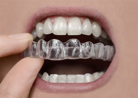 replacement retainers signs      sportingsmiles