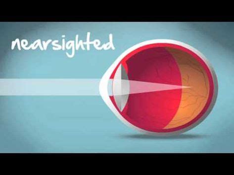 myopia hyperopia astigmatism explained astigmatism lasik eye surgery eye surgery