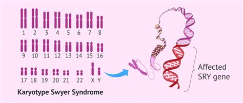 Karyotype In Swyer Syndrome