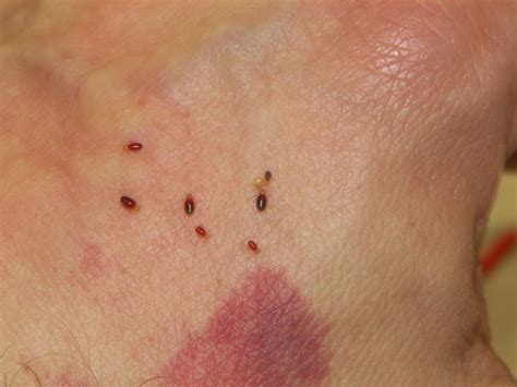 treatments for bedbug bites itching and inflammation