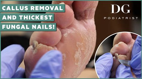 callus removal  feet  thick toenails cutting treatment dg podiatrist  foot scraper