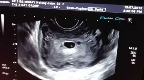 6 week pregnancy ultrasound small sac youtube