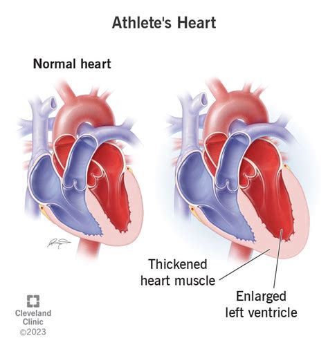 athletes heart  symptoms treatment