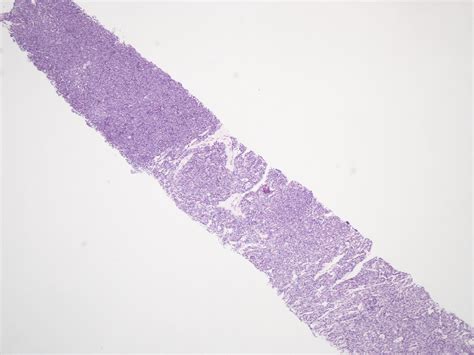 pathology outlines who classification