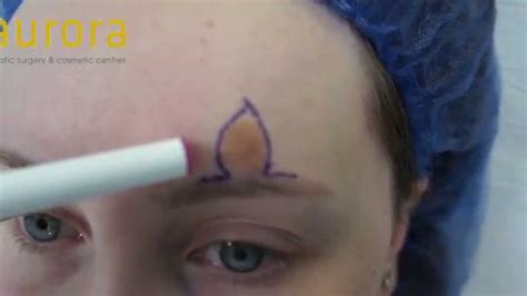mole removal surgery at aurora clinics youtube