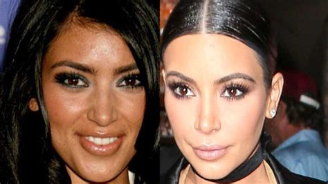 Kim Kardashian S Plastic Surgery Timeline Before And
