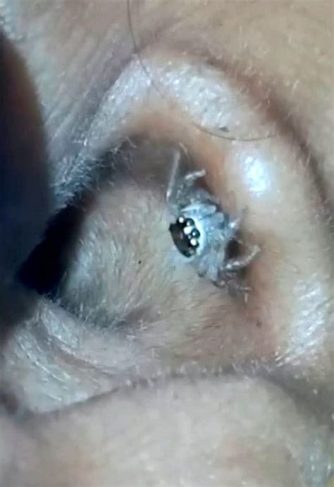 Indian Woman With Headache Discovers Giant Spider Moving In Ear Canal