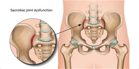 sacroiliac joint dysfunction sij  symptoms treatment