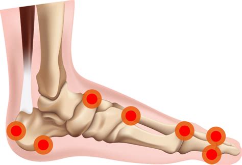 Bone Spur On Inside Of Foot Online Price Save 53 Jlcatj Gob Mx