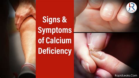 signs symptoms  calcium deficiency youtube