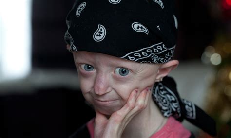 progeria campaigner hayley okines dies at 17 uk news