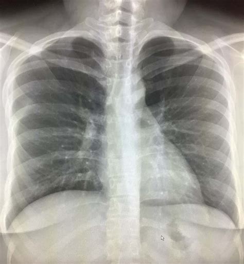 pulmonary nodules  masses chest  ray medschool images