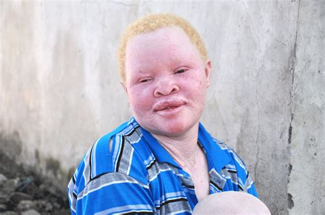fakta ilmiah albino ternyata    ribu  mengalaminya