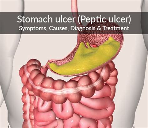Stomach Ulcers Symptoms And Treatment