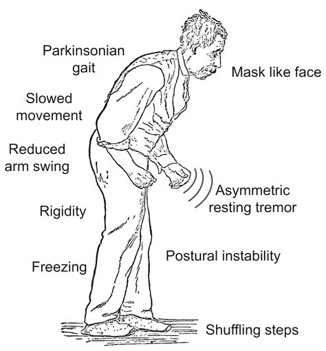 parkinsons  unusual signs     risk