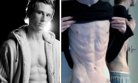 Anorexic Man Who Lived On Just One Apple A Day Recovers To