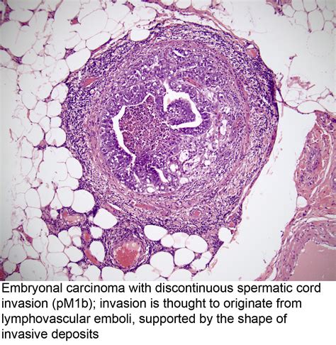 Pathology Outlines Pathologic Tnm Staging Of Testis Germ Cell Tumor