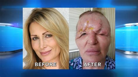 Woman Disfigured By Fillers Forced To Tape Eyes Open In