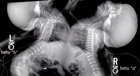 doctor panics when he sees mom s twins like this in her ultrasound now watch what she does