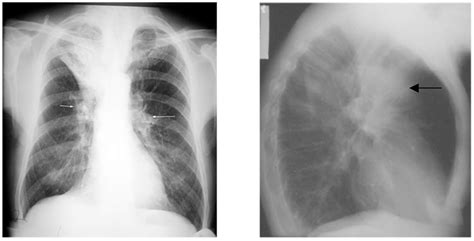 Interpretation Of The Chest Radiograph – Part 2 Wfsa Resources