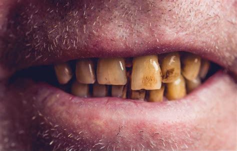 smoking effects on teeth gums and oral health