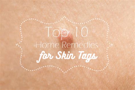 top 10 home remedies for skin tags