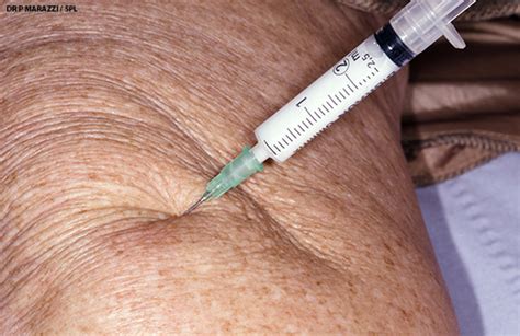 is there a place for intra articular corticosteroid injections in the