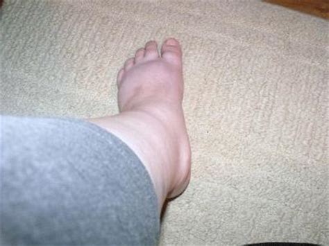 Plantar Fascia Release and Tarsel Tunnel Release on left foot