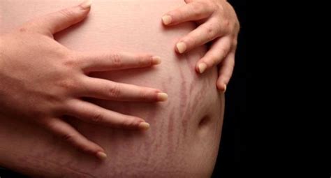 Here’s How To Prevent Stretch Marks During Pregnancy