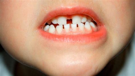 biaya  memperbaiki gigi renggang blog soal