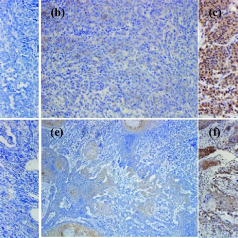 Representative Pd L1 Immunohistochemistry Results With 6c11 3a11 For
