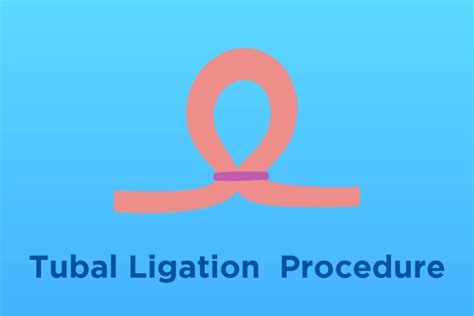 tubal ligation indications procedure recovery