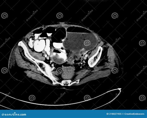 small bowel obstruction ct scan   abdomen stock image image