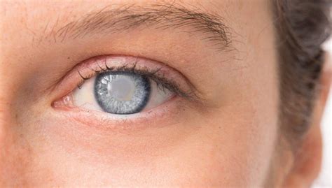 glaucoma    eye disease   treatment glaucoma surgery