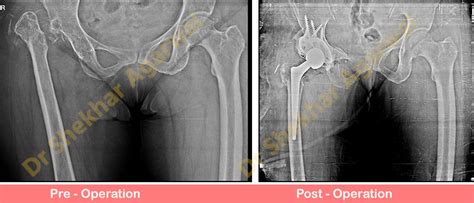revision total hip replacement dr shekhar agarwal