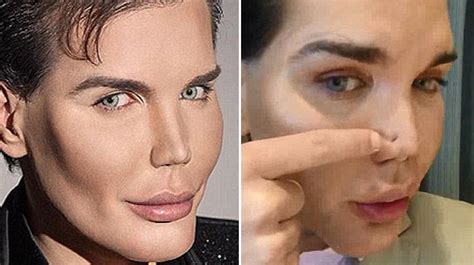 Plastic Surgery Addict Who Became Ken Doll Admitted To Hospital With