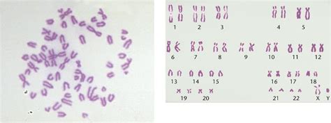 Karyotype Html 02 04 Human Karyotype 