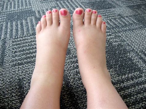 ankles swelling following flying relief and prevention ways new health advisor